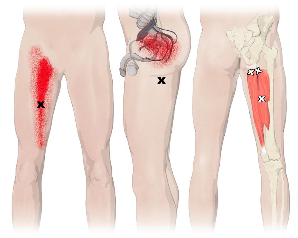 the-adductor-muscles-adductor-magnus-mitchell-integrated-therapy